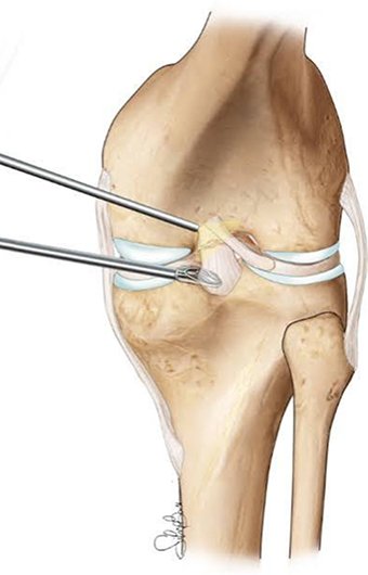 Arthroscopic ACL and PCL Reconstruction